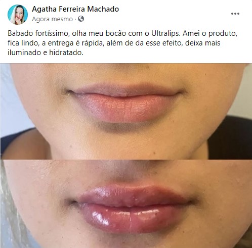 Ultra Lips preço